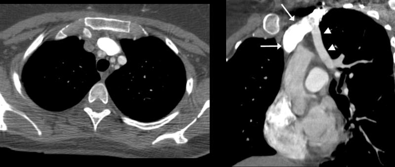 PAPVC Flow Direction With PAPVC of left upper lobe pulmonary vein, flow direction in the anomalous vessel is apparent if contrast in injected into the left arm.
