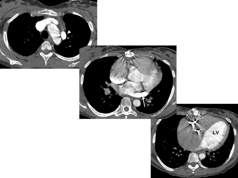 PAPVC Flow Direction CT scan in patient with history of tricuspid valve replacement for tricuspid valve endocarditis shows PAPVC [arrowhead] that forms conduit from LBCV to left inferior pulmonary