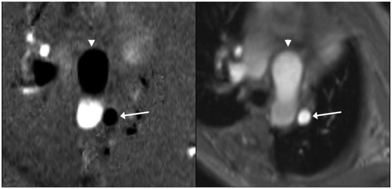 PAPVC Flow Direction Oblique axial phase contrast MRI study on same patient performed after stabilization of