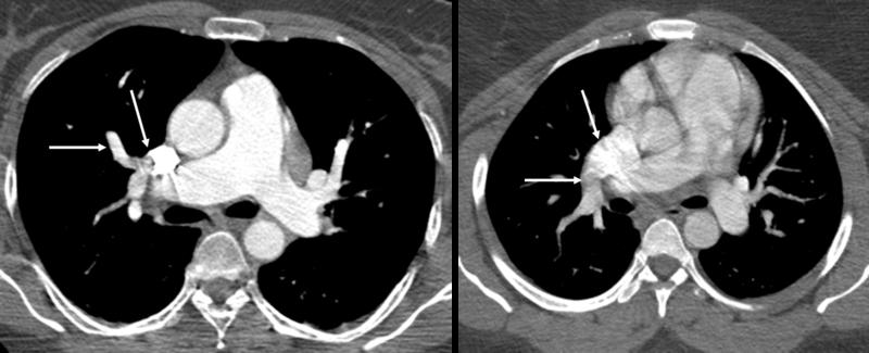 same direction as flow in ascending aorta [arrowhead] (phase image on left with magnitude image on right).