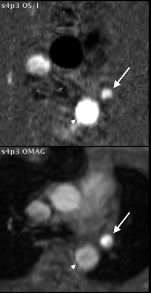 PAPVC Flow Direction Phase contrast image from MRI study confirms direction of flow in anomalous vessel [arrows] is caudad away from