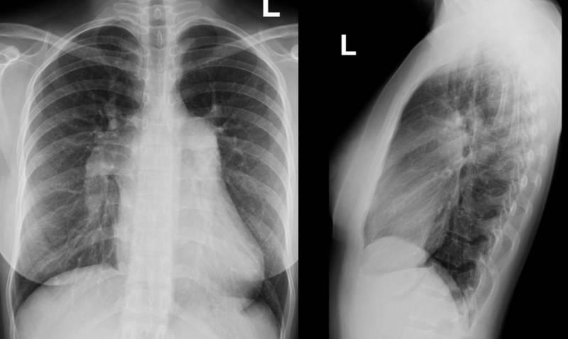PAPVC and ASD CXR shows enlarged pulmonary