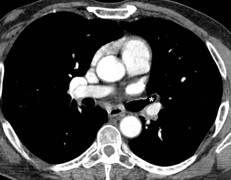 Partial Anomalous Pulmonary Venous Connection (PAPVC) of the Left Upper Lobe Pulmonary Vein Image at a lower level