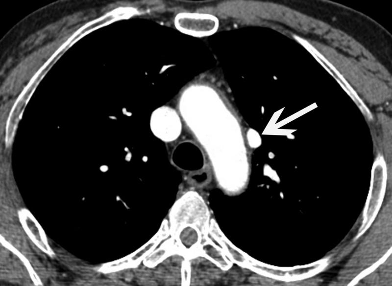 Partial Anomalous Pulmonary Venous Connection (PAPVC) of the Left Upper Lobe Pulmonary Vein 35-year-old man with