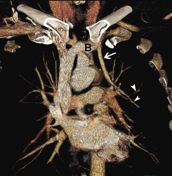 Partial Anomalous Pulmonary Venous Connection (PAPVC) of the Left Upper Lobe Pulmonary Vein Volume rendered view from anterior perspective shows
