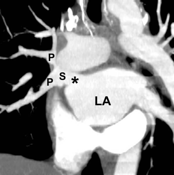 Post-Operative PAPVC Reformatted coronal CT image shows anomalous pulmonary veins (P) draining to