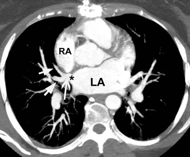 Post-Operative PAPVC Post-operative CT scan shows anomalous pulmonary veins (short arrows) draining to inferior