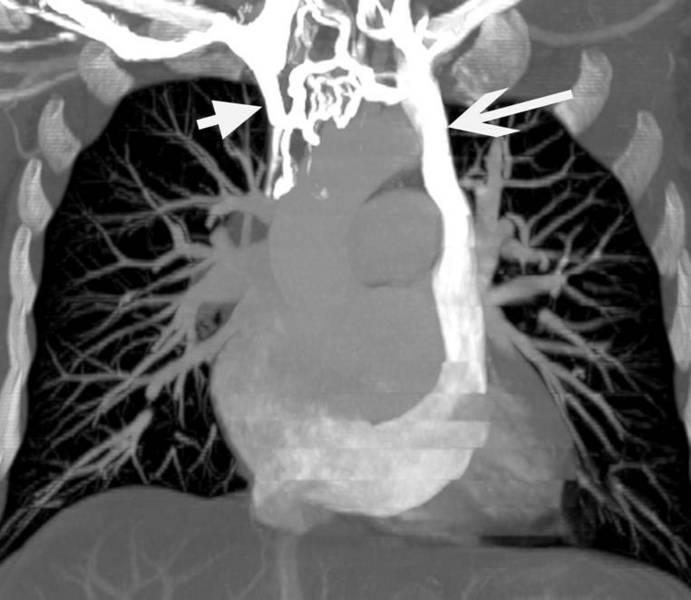 Post-Operative PAPVC Reformatted coronal MIP image shows blood flow pattern above ligated portion of right superior vena cava.