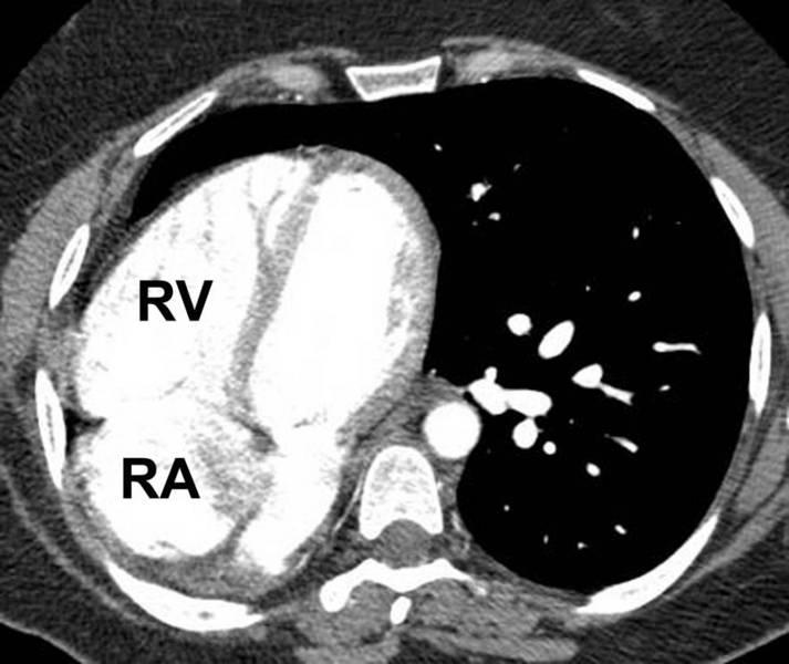 Post-Operative PAPVC Image of heart shows that right atrium (RA) and right ventricle (RV) are dilated compared to left-sided chambers consistent with significant left to