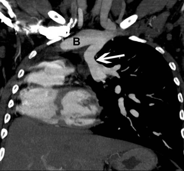 Post-Operative PAPVC Coronal reformatted MIP image shows anomalous left