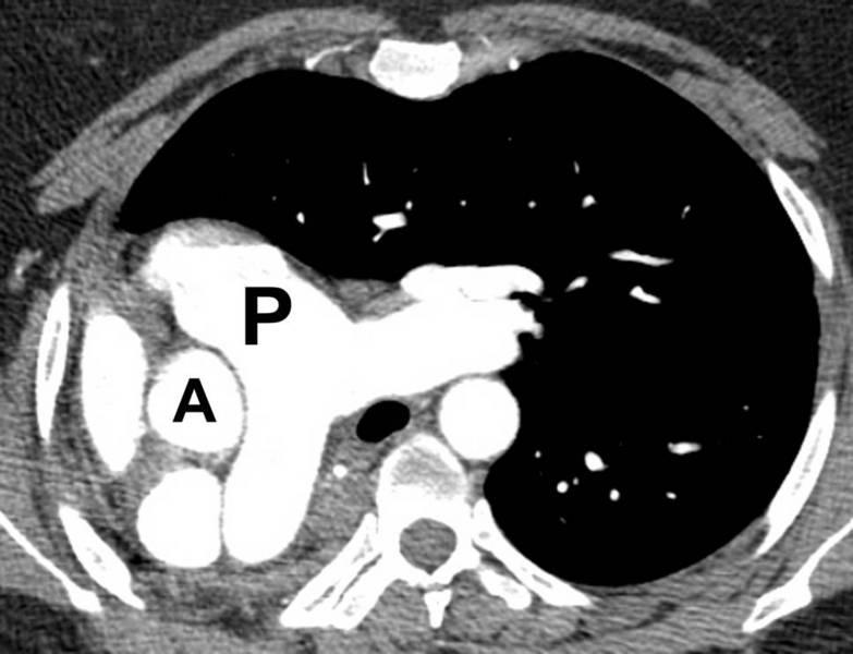 Post-Operative PAPVC CT Image shows that main pulmonary artery (P) is