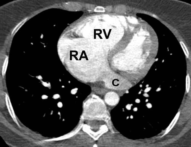 Pre-Operative PAPVC Image through cardiac chambers shows dilated right atrium (RA) and right ventricle (RV)