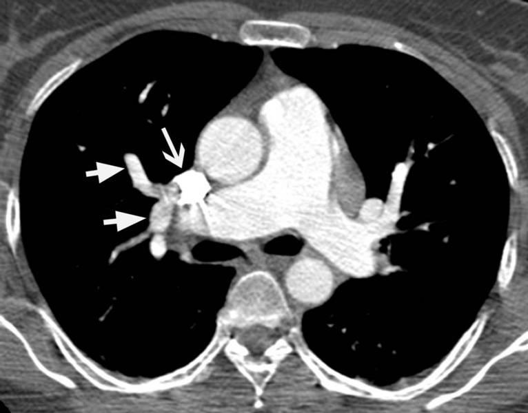 Pre-Operative PAPVC At a slightly higher level additional anomalous pulmonary