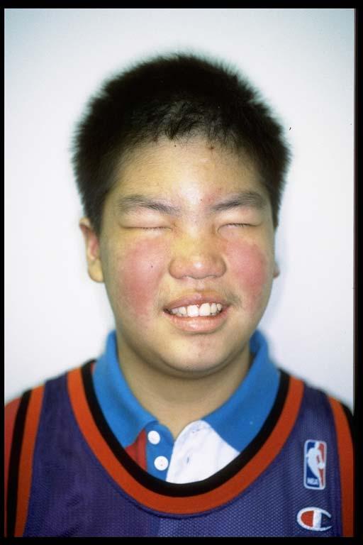 Case Two (continued) Facial rash Diffuse joint