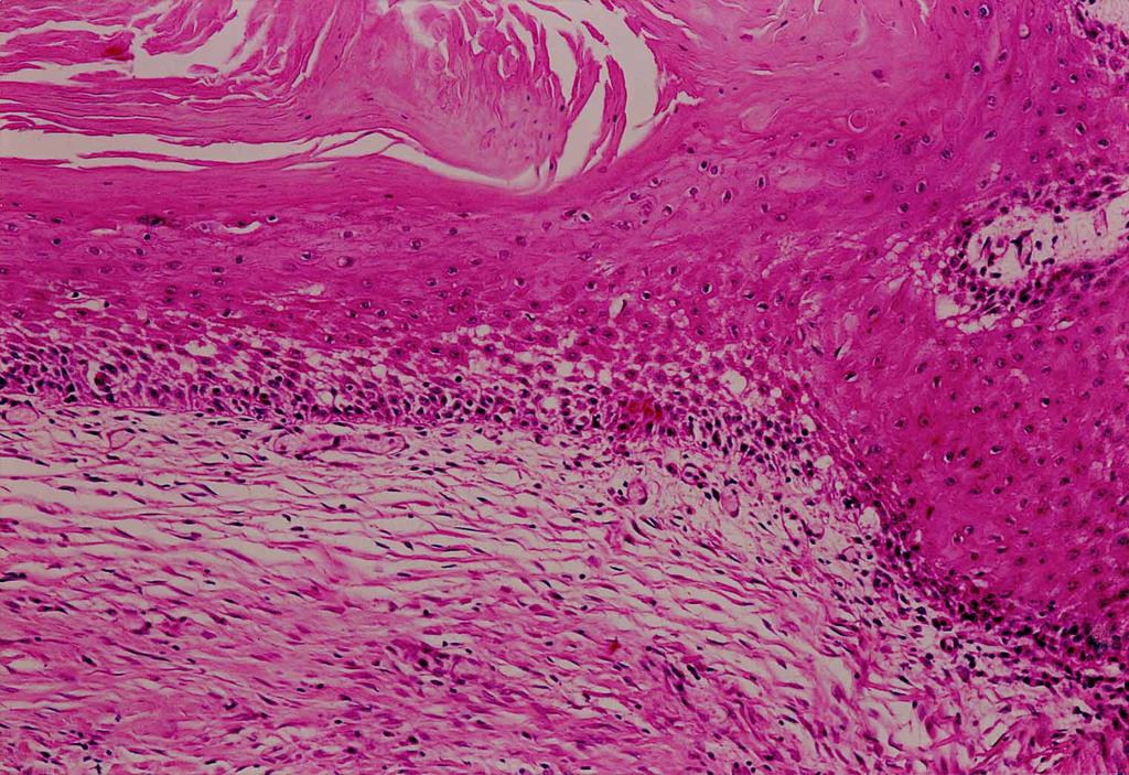 162 Y. OTA et al. Fig. 9 Lower power view showing the transition of the cyst wall into carcinoma. The invasion of neoplastic transformed epithelium into the submucosal stroma is visible. Fig. 10 Lower power view shows proliferation of atypical squamous cells, which are frequently keratinized, and cancer pearl formation.
