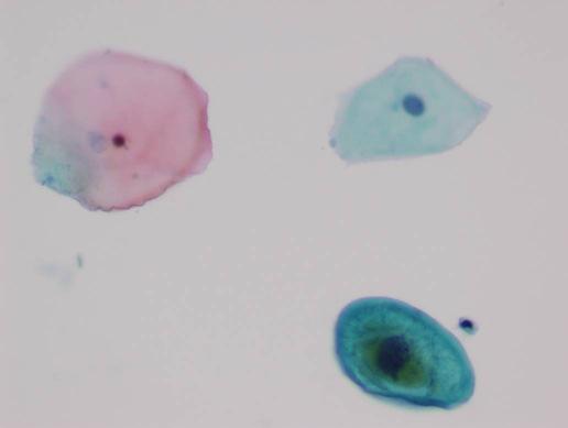 Atypical Squamous Cells ASC refers to cytologic changes suggestive