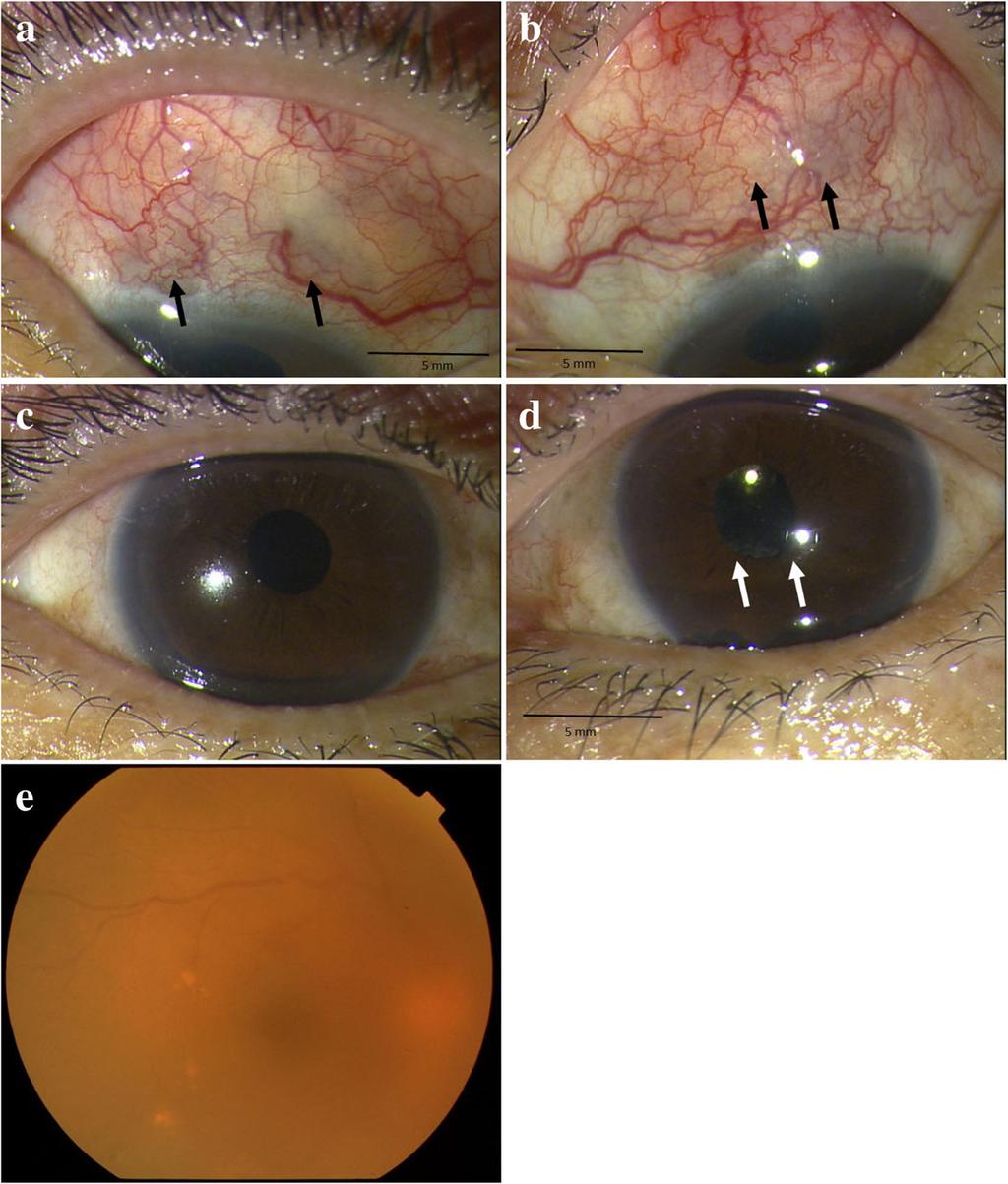 Kobayashi et al. BMC Ophthalmology (2018) 18:129 Page 2 of 5 as bilateral anterior scleritis and prescribed steroid eye drops for treatment.