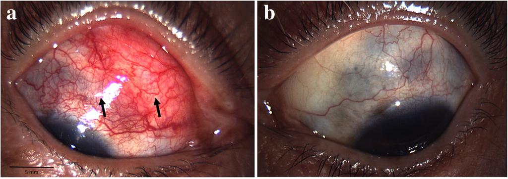 Kobayashi et al. BMC Ophthalmology (2018) 18:129 Page 3 of 5 Fig. 2 Slit-lamp photographs obtained when scleritis relapse, accompanied with an intraocular elevated lesion.