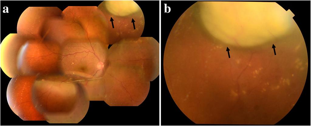 b Superior sclera in her left eye, showing the thinning of tissues (arrows) moderate ocular pain relapsed (Fig.