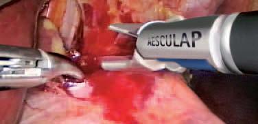 Aesculap Endoscopic Technology Concept Tactility AdTec bipolar stands for a new bipolar instrument technology.