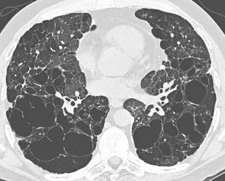 Lung disease More common in adults Smoking = risk factor Can present with: Spontaneous pneumothorax Non- productive