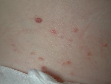 Skin lesions Brownish or purplish papules Frequent in infants Benign if solitary, resolve within 1 yr Must