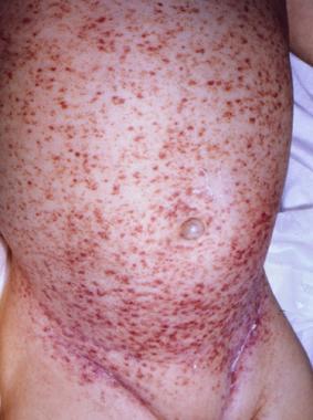 multisystem disease Eczematous rash May present at any age Can by mistaken for seborrheic dermatitis on the