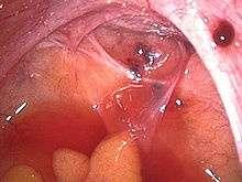 Endoscopic pcture of endometriotic