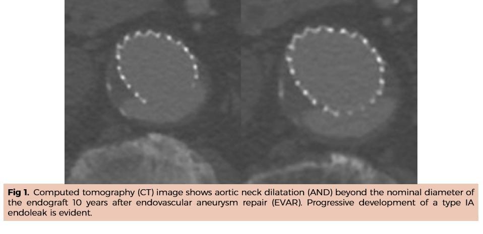 METHODS Baseline of aortic neck diameter measured on preoperative CT angiogram Same level measured at 1-month and 12-month postoperative CT scan