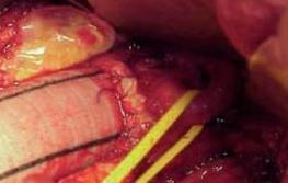 EndoAnchor implants establish surgical