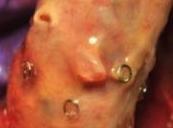 Surgical Anastomosis EndoAnchor implant