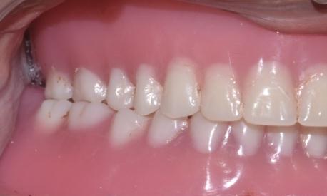 ssume an edge-toedge position of the opposing anterior teeth.