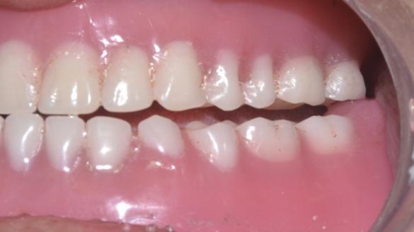movement is performed t the insertion of the dentures,