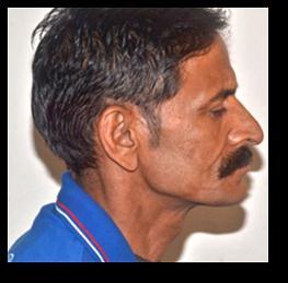 Preoperative () Frontal Profile and () lateral view,