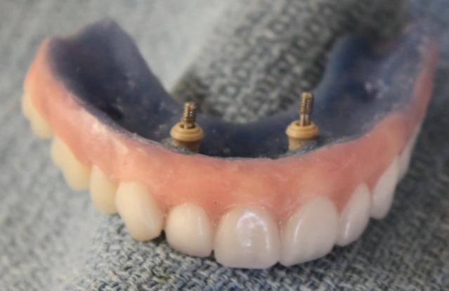 lab for the NobelProcera Implant Bridge Titanium framework to be milled. Note: the lip support is provided by the gingival third of the tooth.
