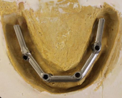 5. NobelProcera Implant Bridge Titanium framework Try-in Un-screw the provisional implant bridge with Unigrip Driver