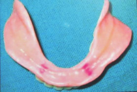 Fig. 6: Markings transferred to mandibular denture Discussion Fig. 7: Intaglio surface of final dentures Fig.