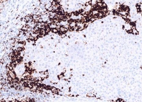 IHC Characteristics of Prescreened Patients: PD-L1 Expression in the UBC Tumor Microenvironment The SP142 assay measures PD-L1 expression based on 4 IHC scoring levels a This assay is optimized for