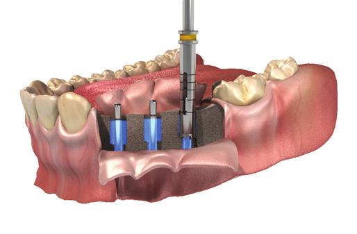 Our ARDS Confident Drilling technique is a unique, precise and simple bone preserving minimal ing technique that saves up to 40% of the bone.