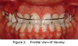 A conventional Hawley type of retainer (Figure 3) was placed to maintain the space for implant supported restorations to replace the