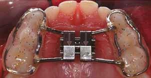 The maxillary protraction springs were then kept in place without adding extraoral forces for another two to three months.