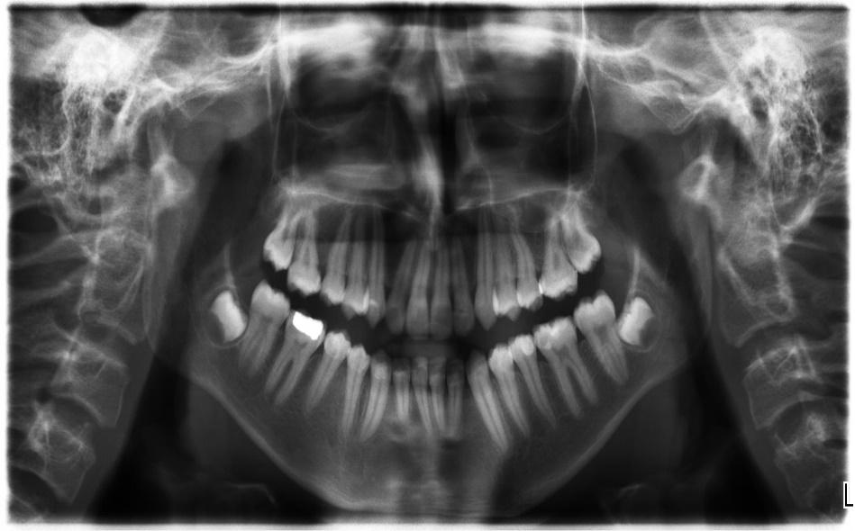 Figure 4B Post debonded Radiographs Discussion This case report showed the results of the treatment of patients with class III malocclusion at an early stage with an efficient orthodontic therapy of