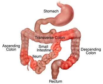 Crohn s disease Crohn s after Dr.