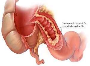 and this can be patchy. Often involves the last part of the small intestine.