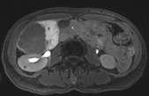 Adenoma Hepatobiliary Phase Focal Liver Lesions Non-cirrhotic Cyst Biliary hamartoma/cystadenoma Abscess Hemangioma Cirrhotic RGN DSN FNH Adenoma T2 Metastases