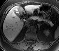 Small Lesion Detection: CT vs. MR B Liver Mets: MR vs.
