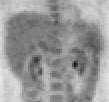 on CT FDG-PET Metastases: 65 Lesions <1cm: 12 Kinkel. Radiology 2002. Sahani. AJR 2005.