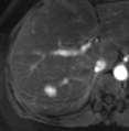 MRI Metastases: 88 Lesions <1cm 33 Liver Blood Supply Arterially Enhancing Lesions: Benign