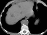 Arterially Enhancing Lesions: Malignant Portal Venous Phase Primary Metastases Carcinoid
