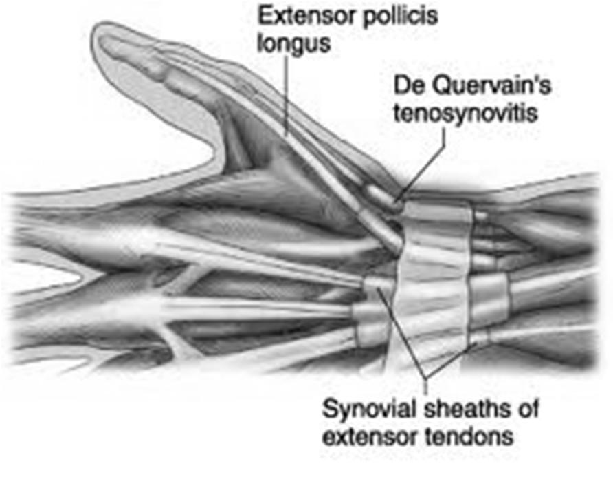 DeQuervain s Disease History Radial sided wrist discomfort Swelling Pain along